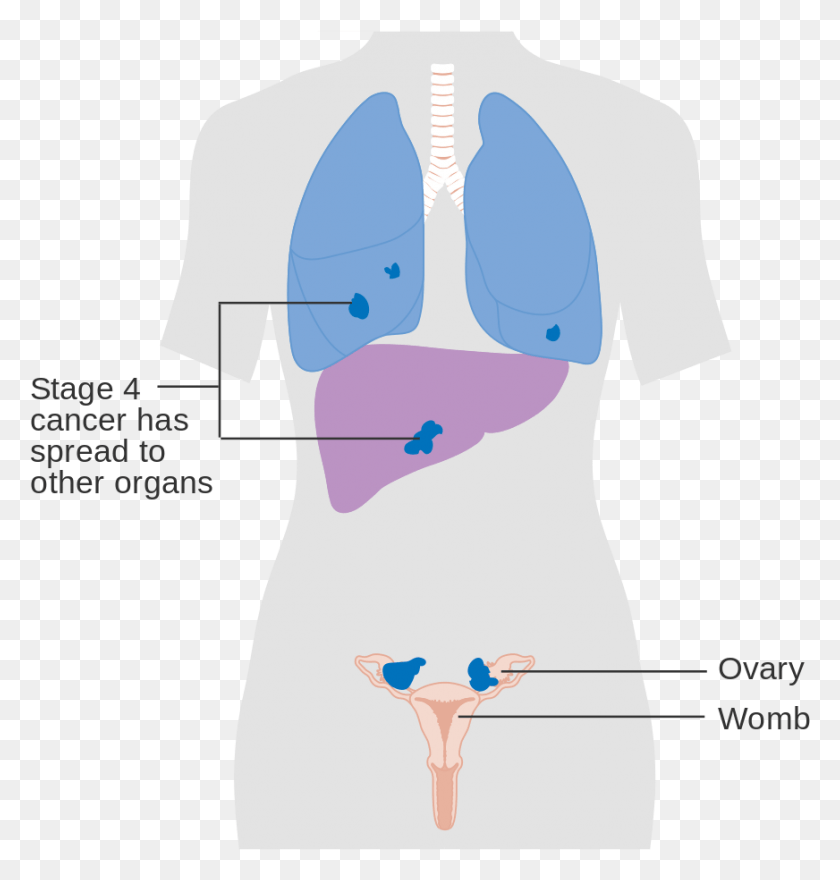 872x917 Diagram Showing Stage 4 Ovarian Cancer Cruk Stage 4 Ovarian Cancer Criteria, Plot, Hip, Neck HD PNG Download