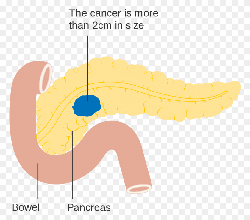 1041x906 Diagram Showing Stage T2 Cancer Of The Pancreas Cruk Pancreatic Cancer, Label, Text, Fungus HD PNG Download