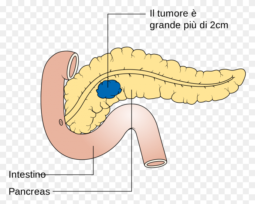 1277x1003 Diagram Showing Stage T2 Cancer Of The Pancreas Cruk Tumore Neuroendocrino Pancreas, Interior Design, Indoors, Teeth HD PNG Download