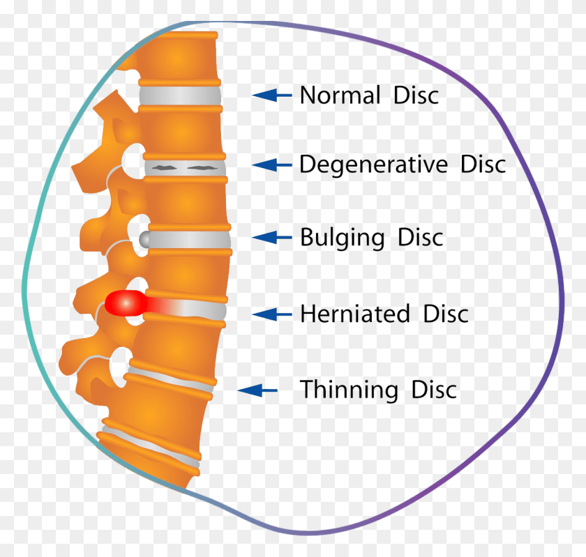 1112x1054 Discs Damaged Herniated Discs, Text, Plot, Diagram HD PNG Download