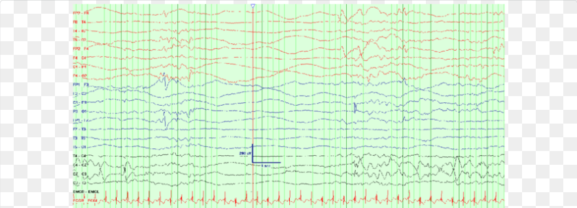 850x307 Eeg Background Showing Burst Suppression Pattern Burst Suppression, Chart Transparent PNG