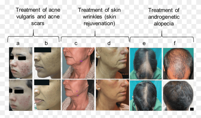 851x472 Effects Of Mn Treatment Against Acne Skin Wrinkles Parallel, Jaw, Person, Human HD PNG Download