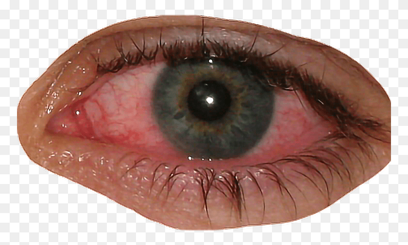 770x446 Descargar Png Ojo Inyectado En Sangre Red Eye Bloodshoteyes Facefreetoedit Pink Eye, Lente De Contacto, Piel, Pez Hd Png