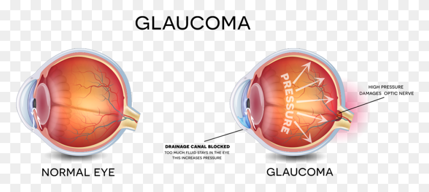 927x376 Eyesmart American Academy Of Ophthalmology Prevent Glaucoma, Clothing, Apparel, Toothpaste HD PNG Download
