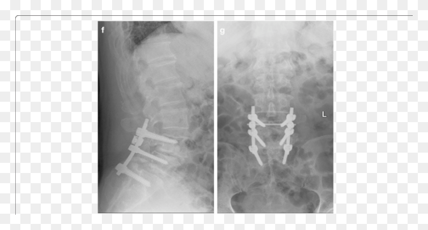 850x428 F G Postoperative Lumbar Spine Showing L4 L5 Correction X Ray, X-ray, Ct Scan, Medical Imaging X-ray Film HD PNG Download