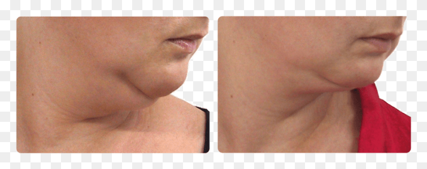 895x314 Face Slimming 417 52 Kb Carboxy Therapy Fre Efter, Skin, Neck, Shoulder HD PNG Download