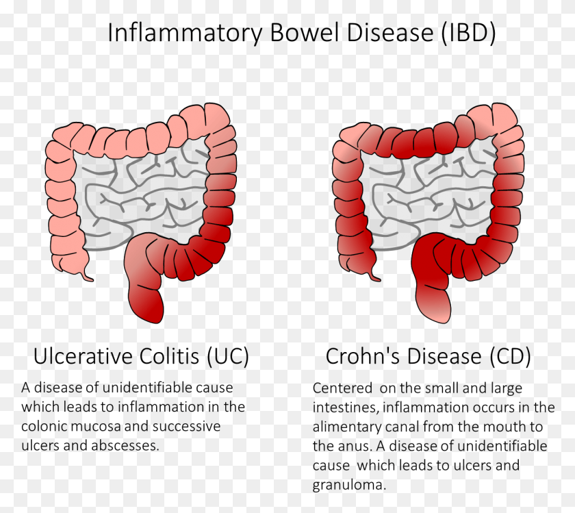 1244x1099 Figure 1 Ibd Is A Group Of Diseases Which Cause Inflammation Inflammatory Bowel Disease Adalah, Jaw, Teeth, Mouth HD PNG Download