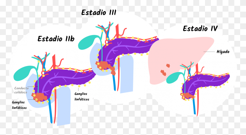 1556x804 Full Cancer Head Of Pancreas Stage, Outdoors, Graphics HD PNG Download