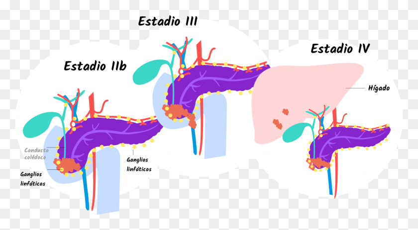 1556x804 Full Cancer Head Of Pancreas Stage, Outdoors, Graphics Descargar Hd Png