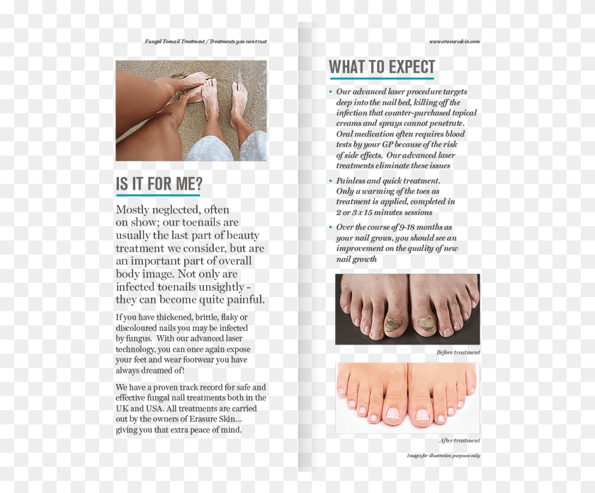 520x637 Fungal Nail Removal Leaflet Brochure, Person, Human, Advertisement HD PNG Download