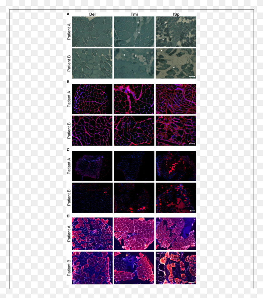 850x974 Histological Markers Of Muscle Degeneration In Torn Illustration, Purple, Light, Rug HD PNG Download