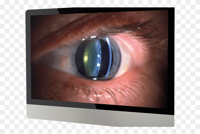 630x501 How To Get The Most Out Of Your Slit Lamp Camera Lampe Fente, Contact Lens, Monitor, Screen HD PNG Download