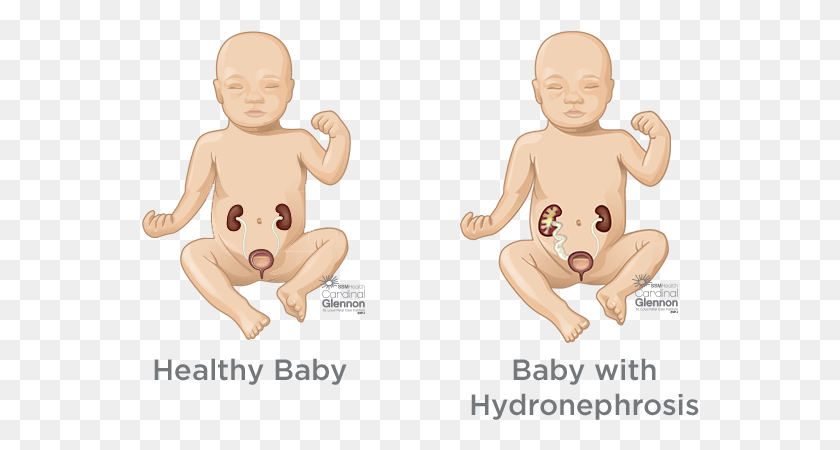 558x390 If Your Baby Has Restricted Urine Flow Or Urine Reflux Hydronephrosis In Infants, Person, Human, Face HD PNG Download