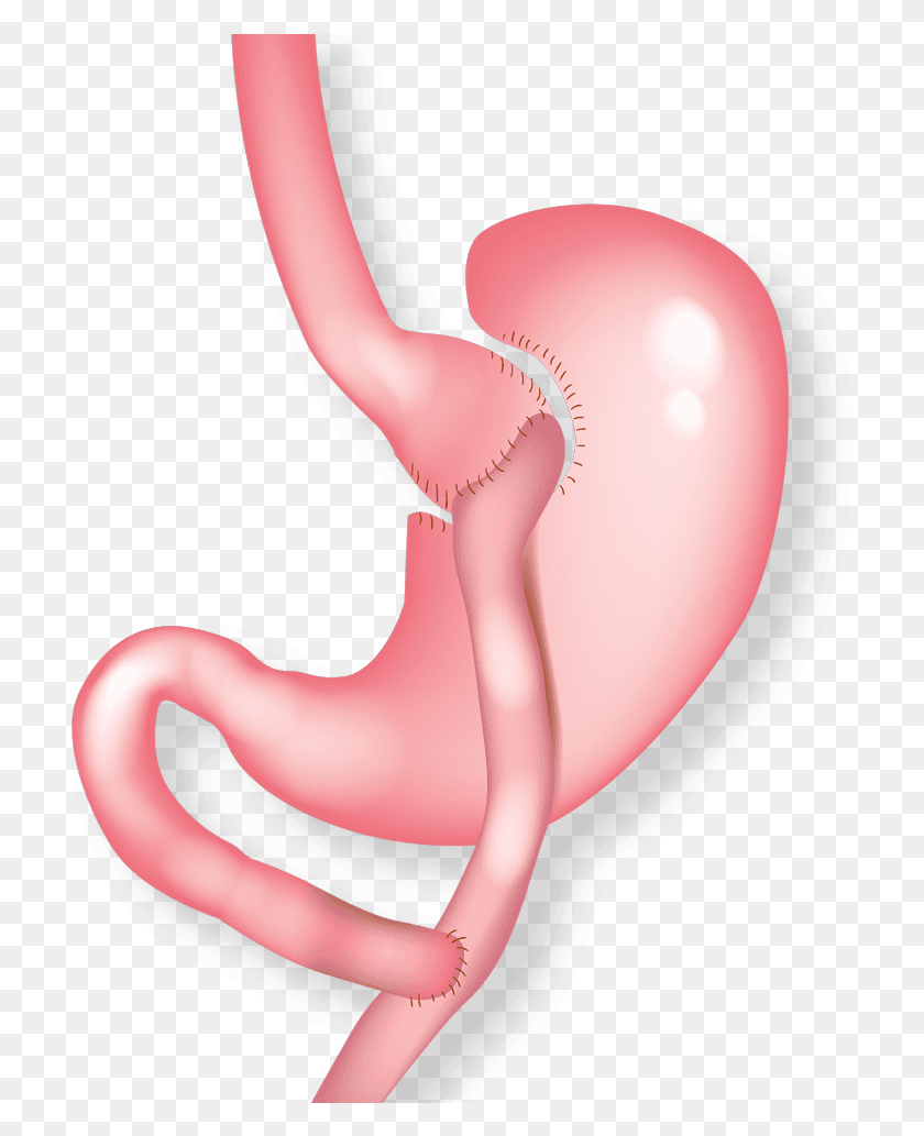 712x973 Illustration Of Gastric Bypass Balloon, Stomach, Person, Human HD PNG Download