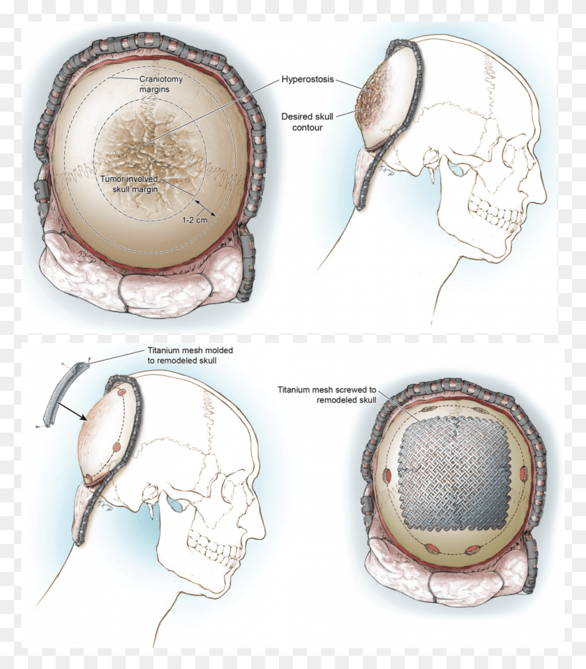 1801x2077 Illustrations Of The In Situ Cranioplasty Method Circle, Plot, Diagram, Wristwatch HD PNG Download
