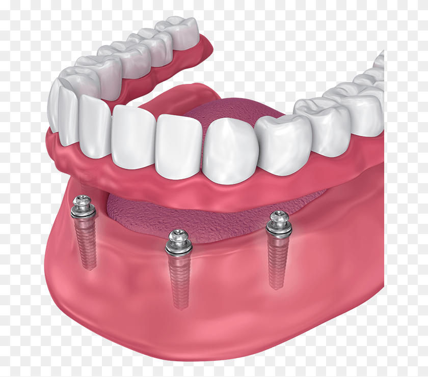 669x681 Implant Supported Dentures Implant Supported Overdenture, Teeth, Mouth, Lip HD PNG Download