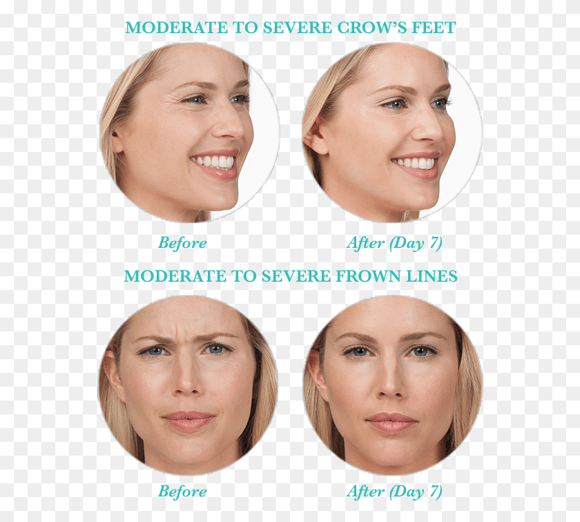 562x696 In Some Cases Botox Can Also Be Used To Reduce Or Smile Line Botox, Face, Person, Human HD PNG Download