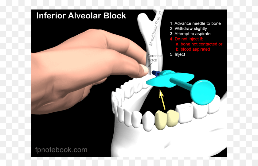 641x481 Inferior Alveolar Nerve Block Inferior Alveolar Nerve Block In Children, Jaw, Person, Human HD PNG Download