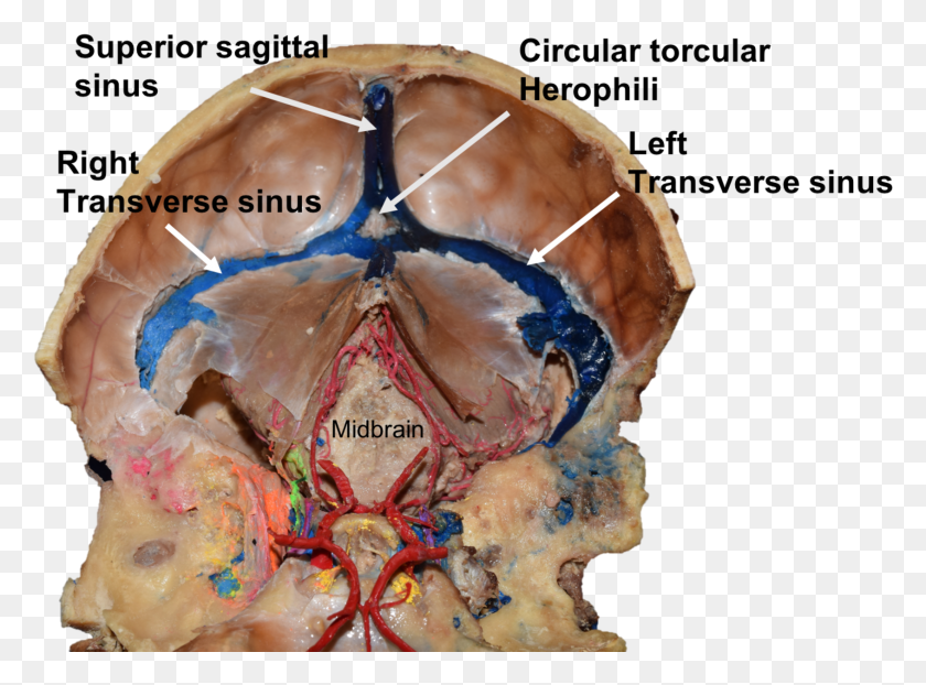 1691x1219 Internal View Of The Case Presented Herein Superior Sagittal Sinus Cadaver, Cream, Dessert, Food HD PNG Download