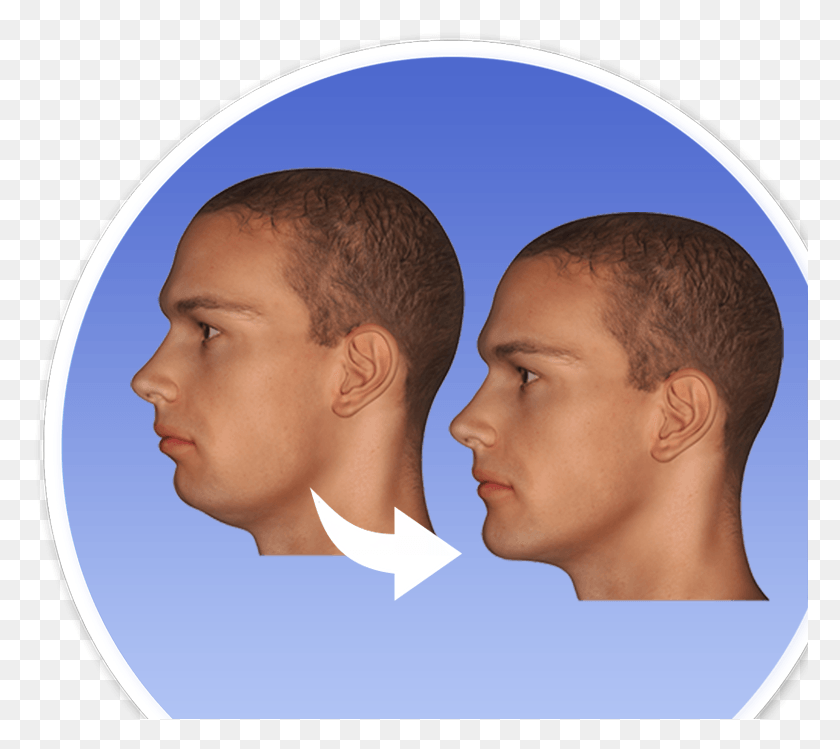 776x689 Jaw Surgery Jaw Unbalanced Surgery, Head, Person, Human HD PNG Download