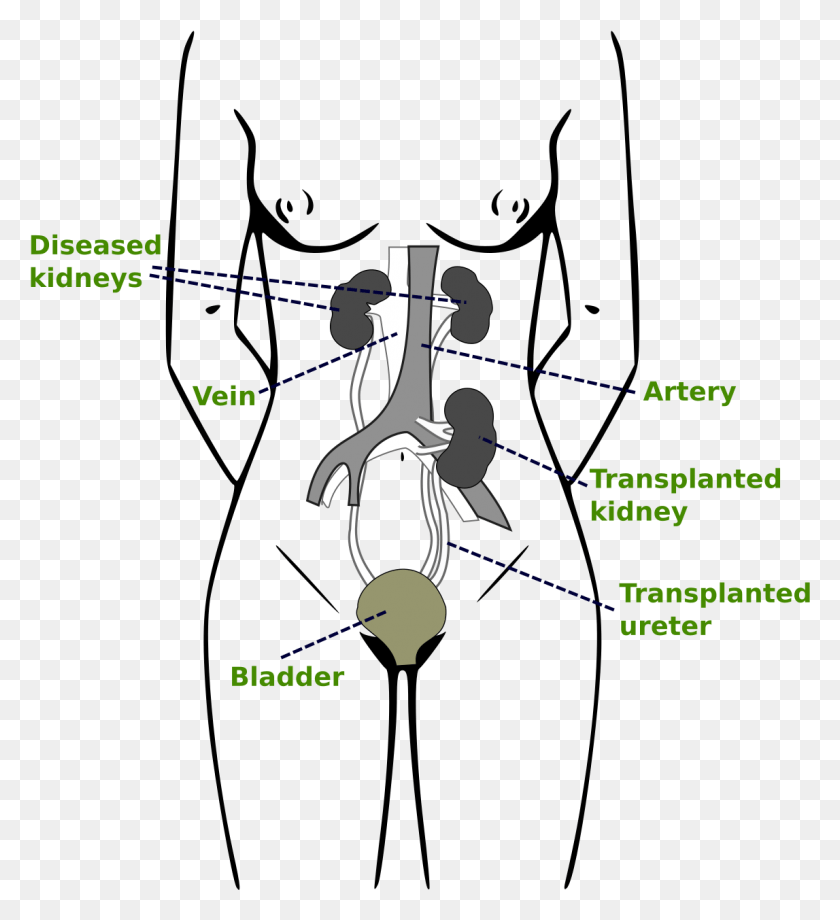 1147x1265 Kidney Transplantation Pdf Transplantable Organs, Utility Pole, Diagram, Plot HD PNG Download