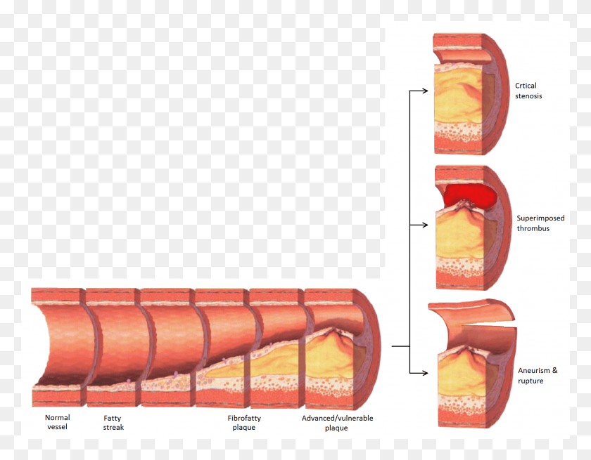 1918x1464 Late Complications Of Atherosclerosis Following Diagram Shows How An Atherosclerosis Plaque, Hot Dog, Food, Dynamite HD PNG Download