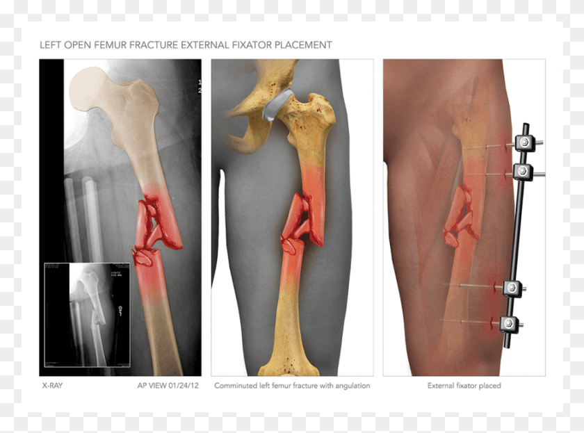 871x629 Left Femur Fracture And External Fixator Placement Bone, Hip, Shoulder, Plot HD PNG Download