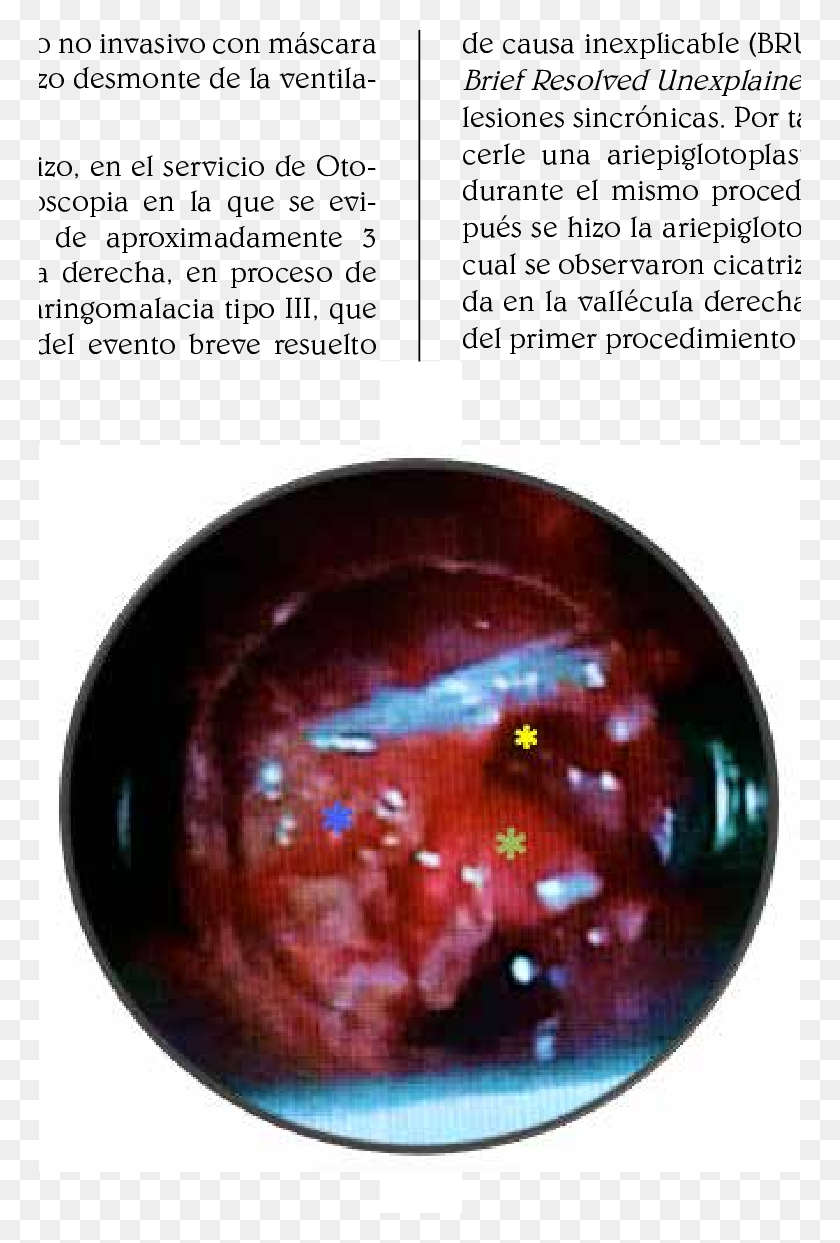 762x1183 Lesin En La Vallcula Derecha Epiglotis Asterisco Crystal, Ornament, Gemstone, Jewelry HD PNG Download
