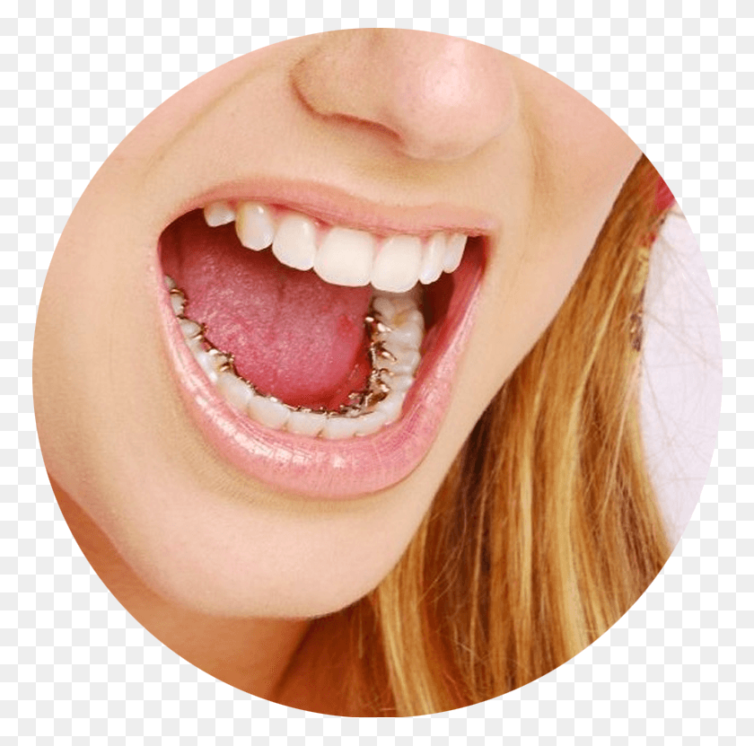 771x771 Lingual Braces Behind The Teeth Braces, Mouth, Lip, Person HD PNG Download