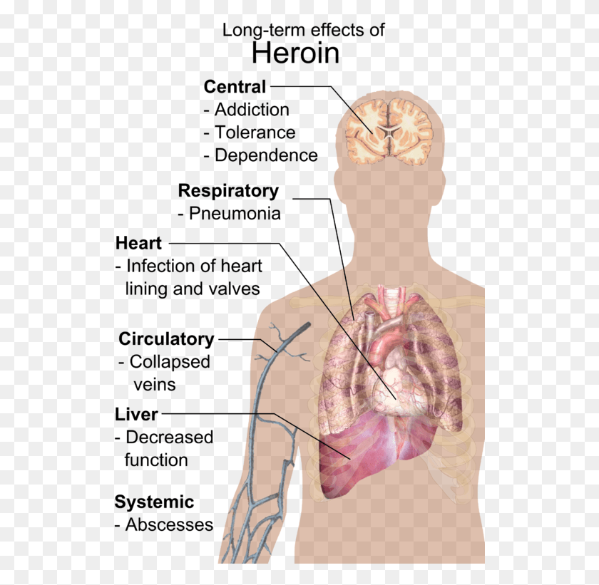 521x761 Long Term Effects Of Heroin Long Term Effects Of Heroin, Neck, Torso, Shoulder HD PNG Download