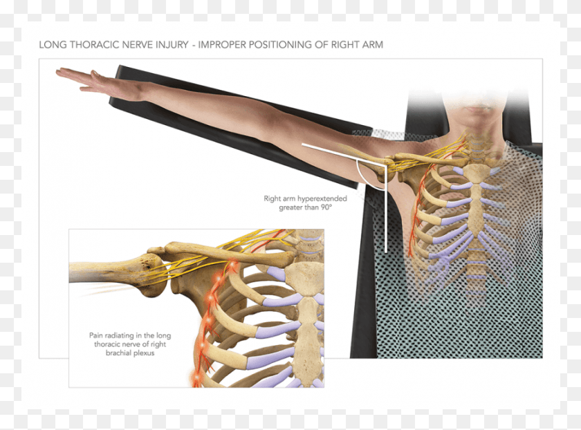 872x629 Long Thoracic Nerve Injury Bone, Skeleton, Axe, Tool Descargar Hd Png