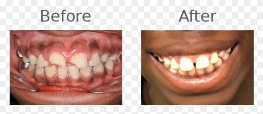 1025x403 Afortunadamente, La Boca De Este Estudiante Estaba En Buena Forma Y Fotografía Macro, Mandíbula, Dientes, Labio Hd Png