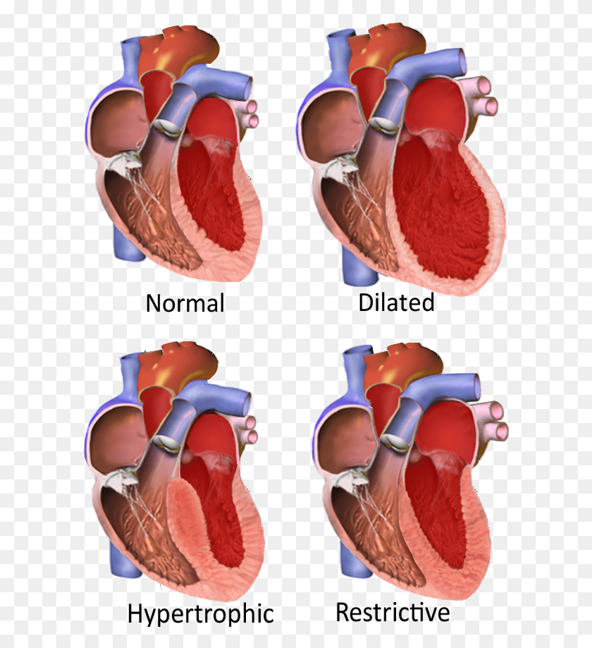 607x859 Major Categories Of Cardiomyopathy Hypertrophic Cardiomyopathy, Clothing, Apparel, Plant Descargar Hd Png