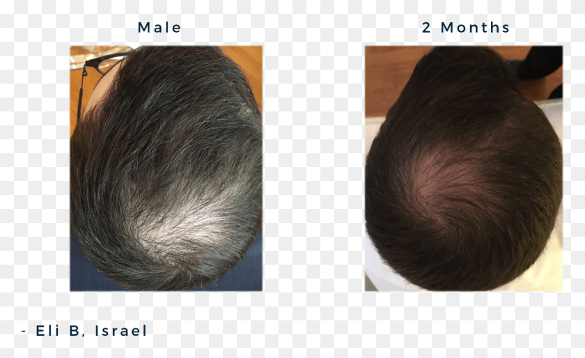 1219x711 Descargar Png / La Alopecia Androgénica Masculina Png