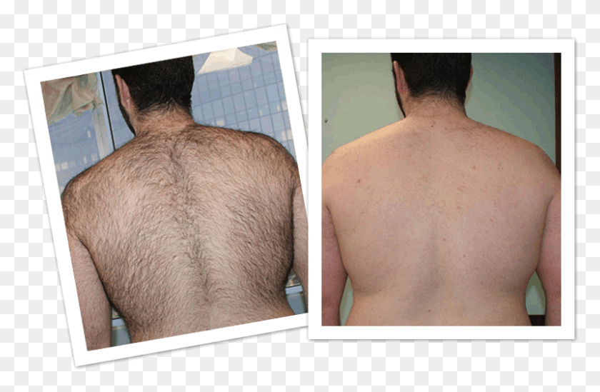 800x502 Male Back Laser Hair Removal Before And After Sprej Na Odstrnenie Chpkov, Shoulder, Person, Human HD PNG Download