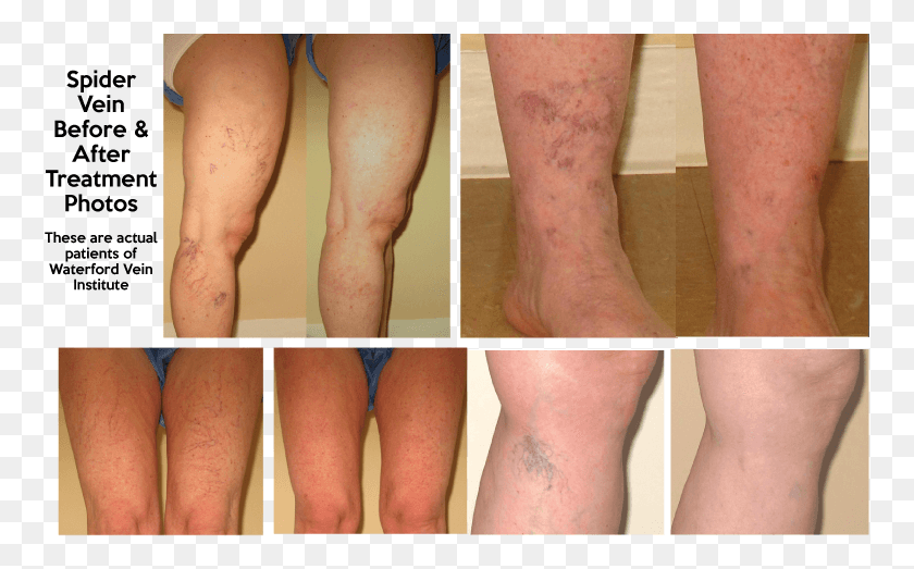 759x463 Many People Often Seek Treatment For Spider Veins Due Scar, Knee, Person, Human HD PNG Download