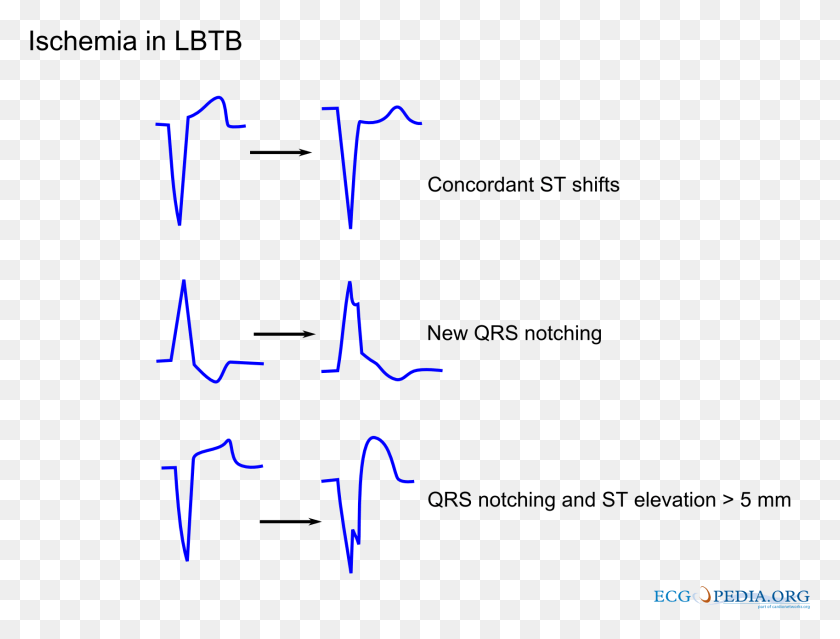 1698x1261 Mi Lbbb Difference Between Ischemia And Infarction Ecg, Text, Number, Symbol HD PNG Download