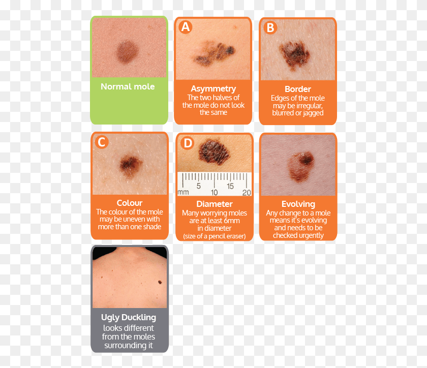 488x664 Non Melanoma Skin Cancer Skin Cancer Symptoms, Plant, Text, Fruit HD PNG Download