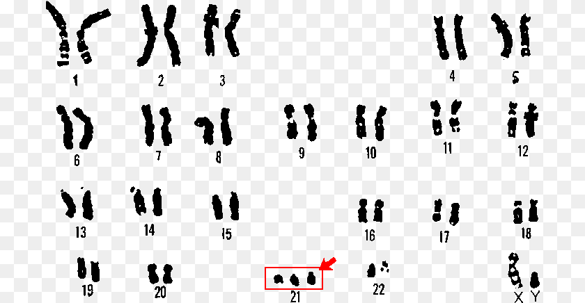 Nondisjunction Down Syndrome Karyotype PNG