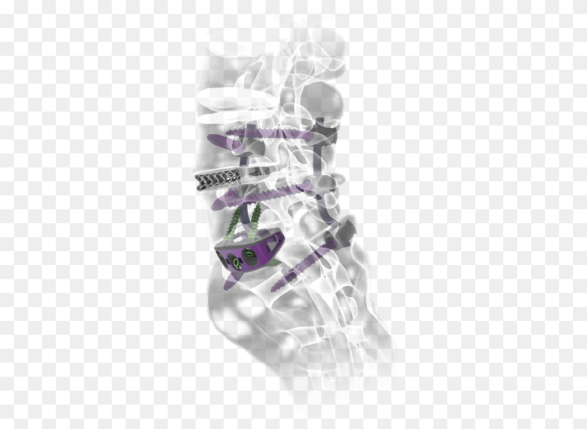 Nuvasive Precept, Baby, Person Sticker PNG