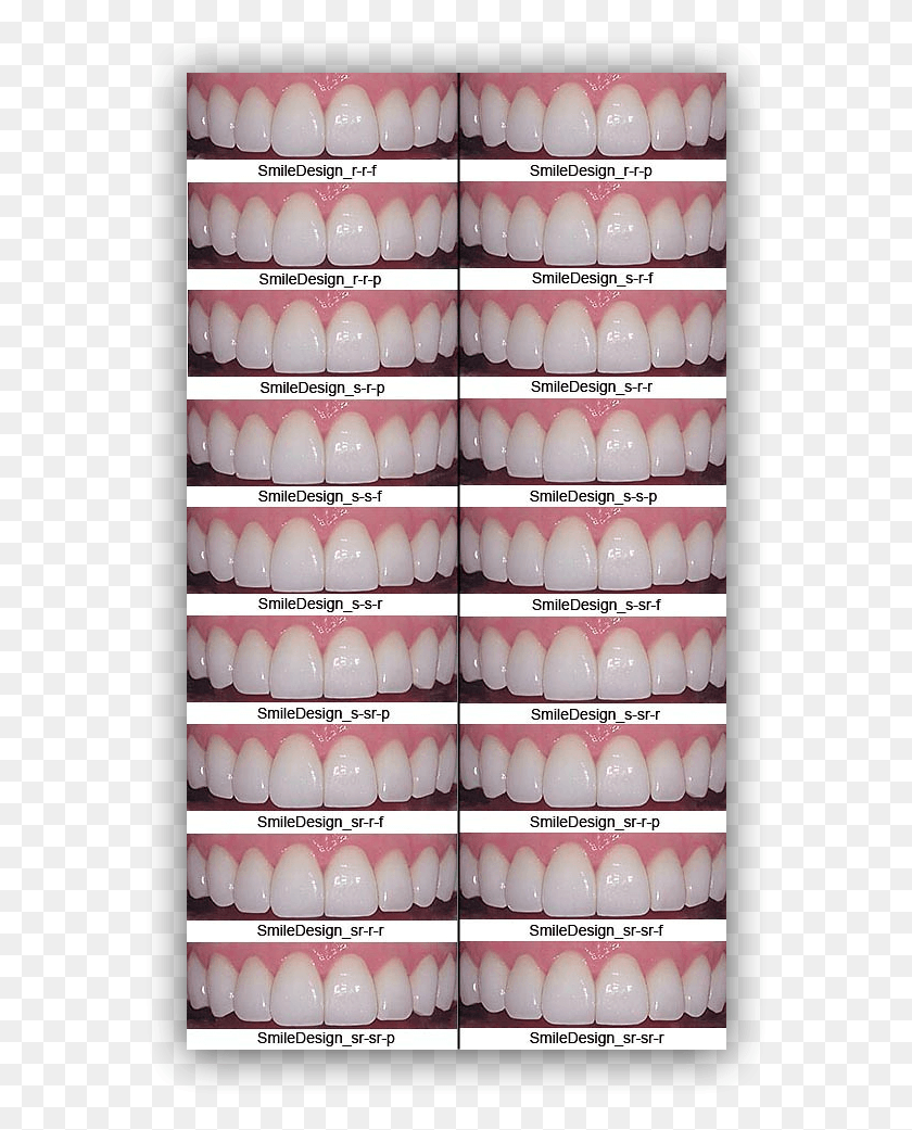 578x981 Overbite Correction Overbites Commonly Known As Buck Porcelain Veneers Styles, Teeth, Mouth, Lip HD PNG Download