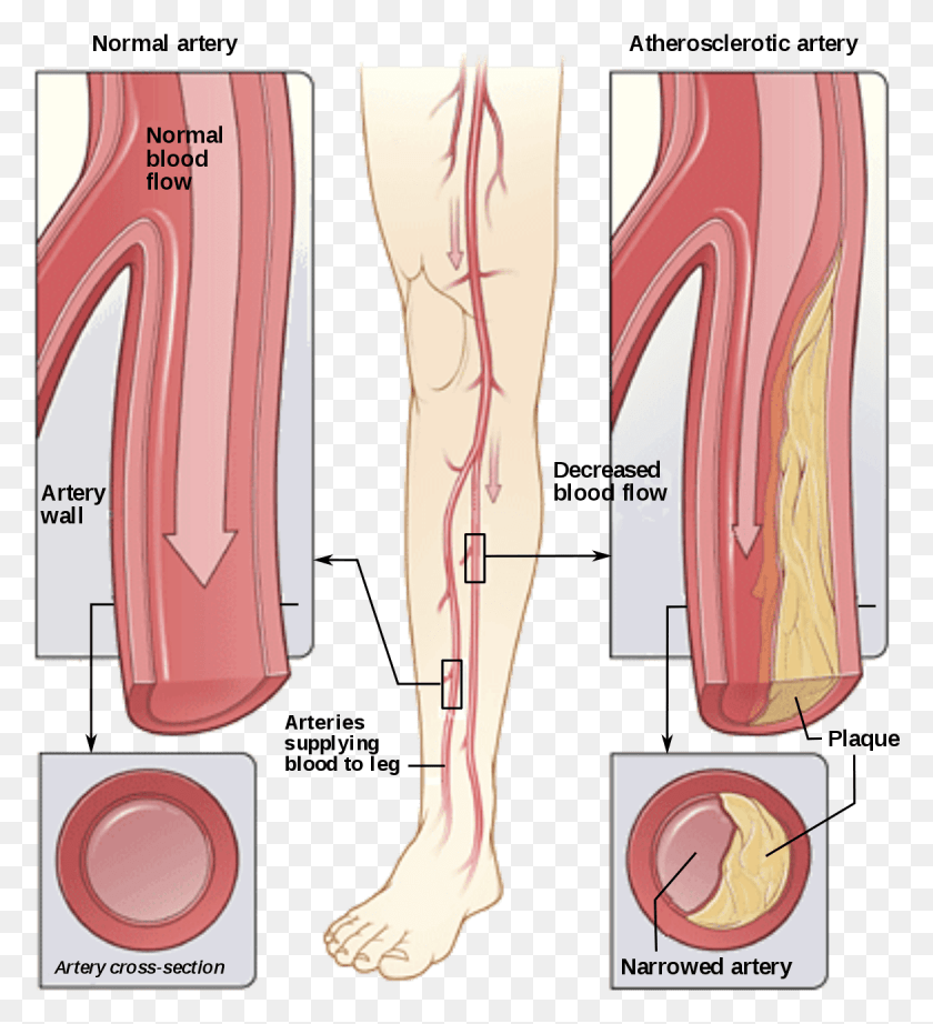 1170x1293 Peripheral Arterial Disease Peripheral Artery Disease, Clothing, Apparel, High Heel Descargar Hd Png