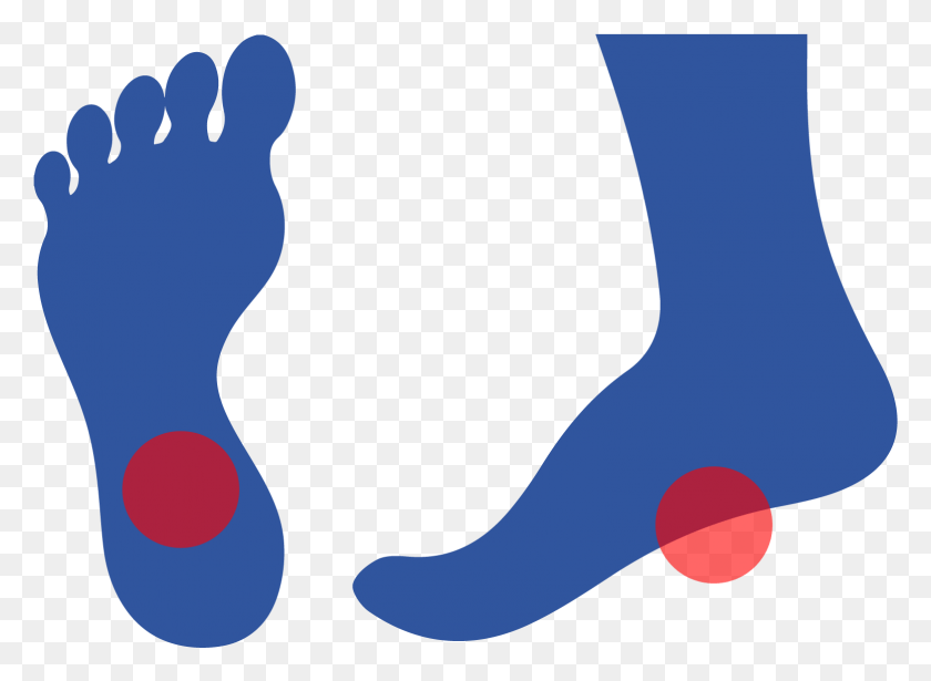 1555x1107 Plantar Fasciitis Is Caused By Inflammation Of A Thick, Hand, Heel HD PNG Download