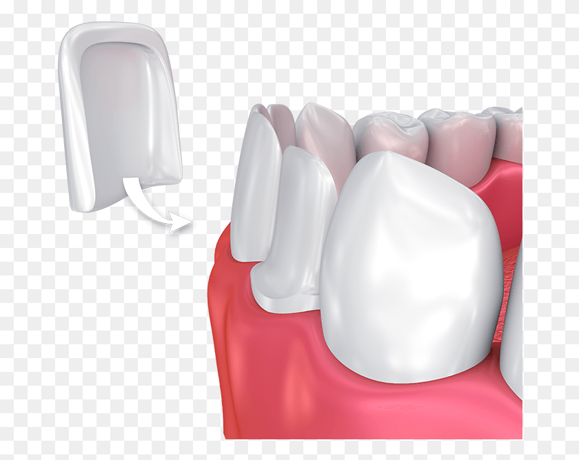 676x608 Porcelain Veneers Dental Veneers, Clothing, Apparel, Teeth HD PNG Download