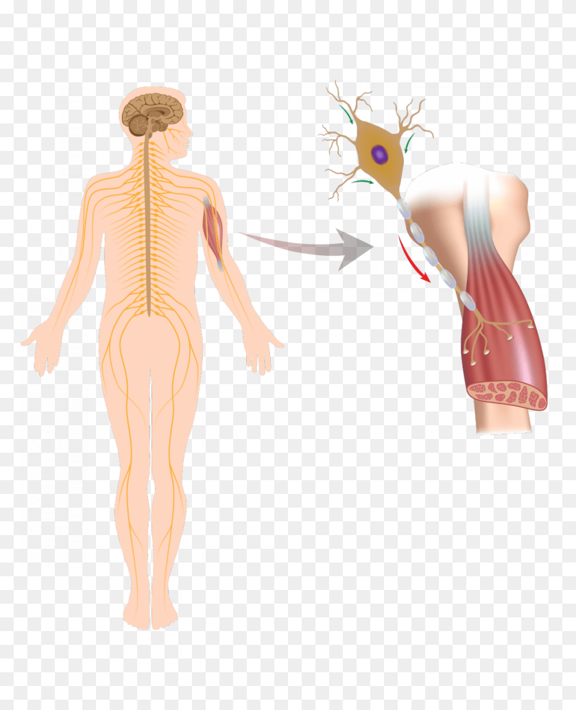 960x1200 Post Polio Syndrome Sindrome Post Polio, Person, Human, Skeleton HD PNG Download