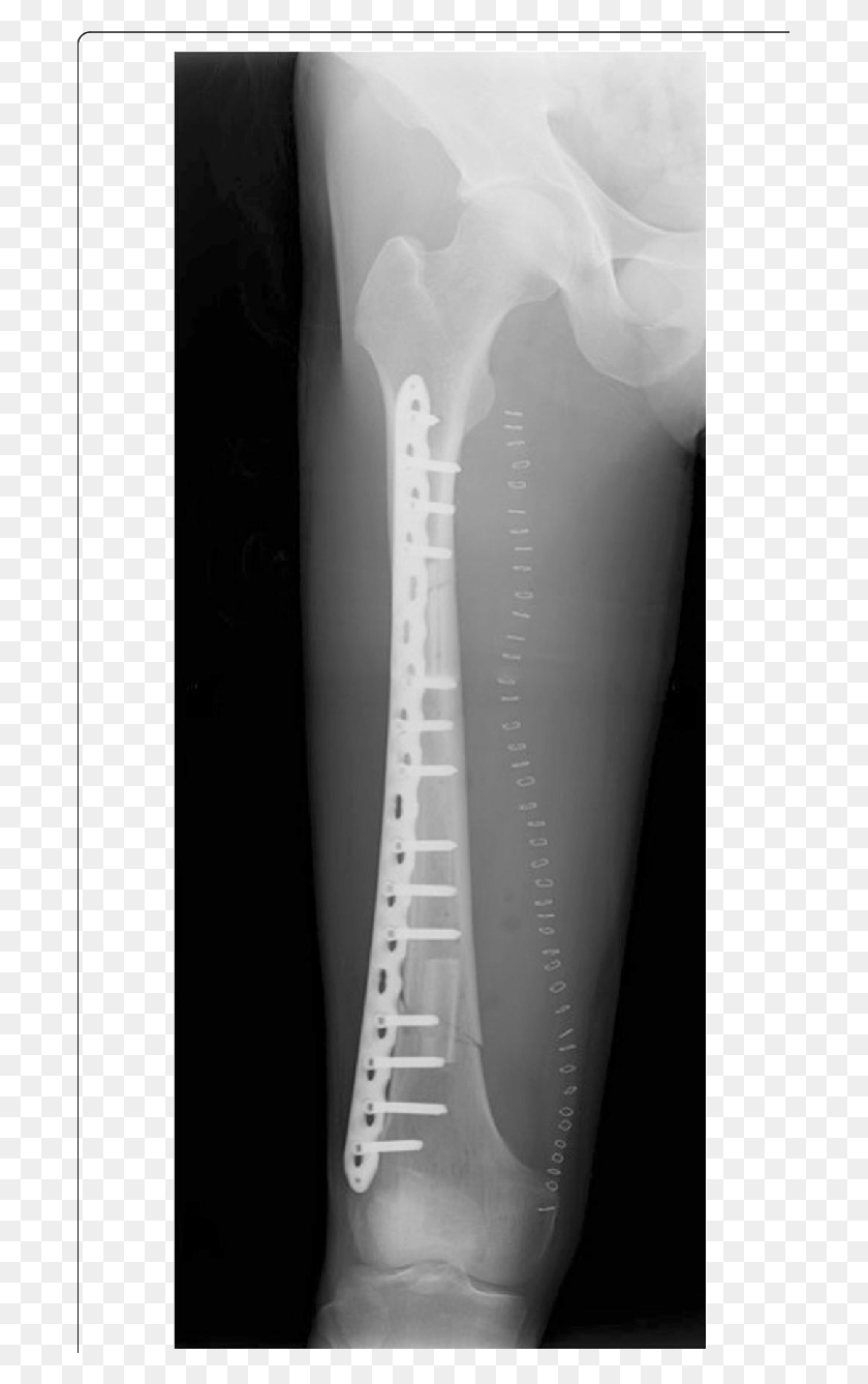 689x1278 Postoperative Radiography After The Femur Reconstruction X Ray, X-ray, Medical Imaging X-ray Film, Ct Scan HD PNG Download