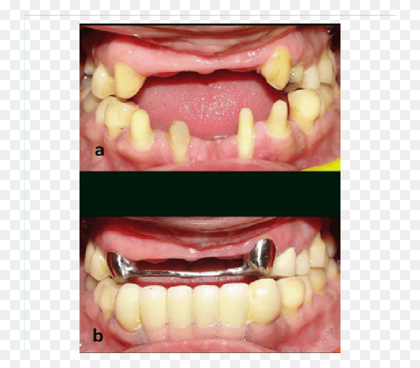 744x676 Pre Rehabilitation View And B Intraoral View Post Tongue, Jaw, Teeth, Mouth HD PNG Download