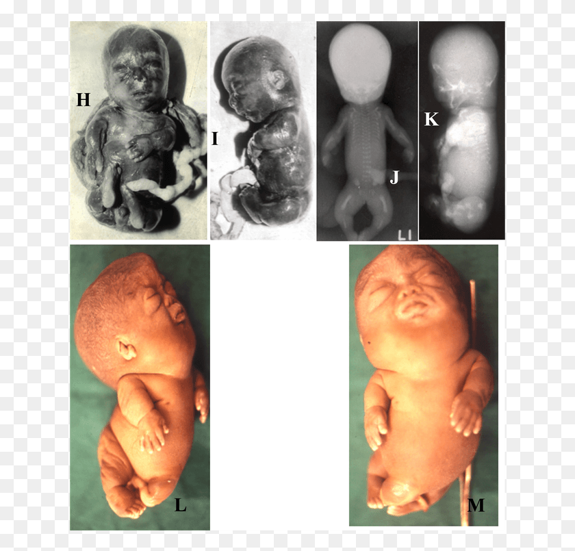 637x745 R Showing Lethal Skeletal Dysplasia Baby, Head, Person, Human HD PNG Download