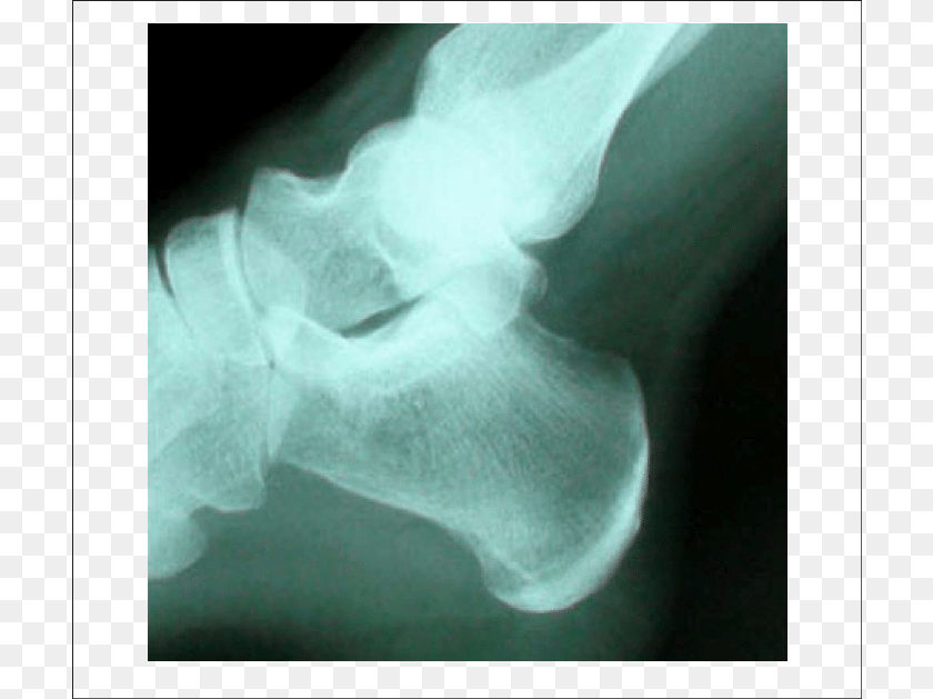Radiograph Before Shock Wave Therapy Radiography, Person, X-ray Sticker PNG