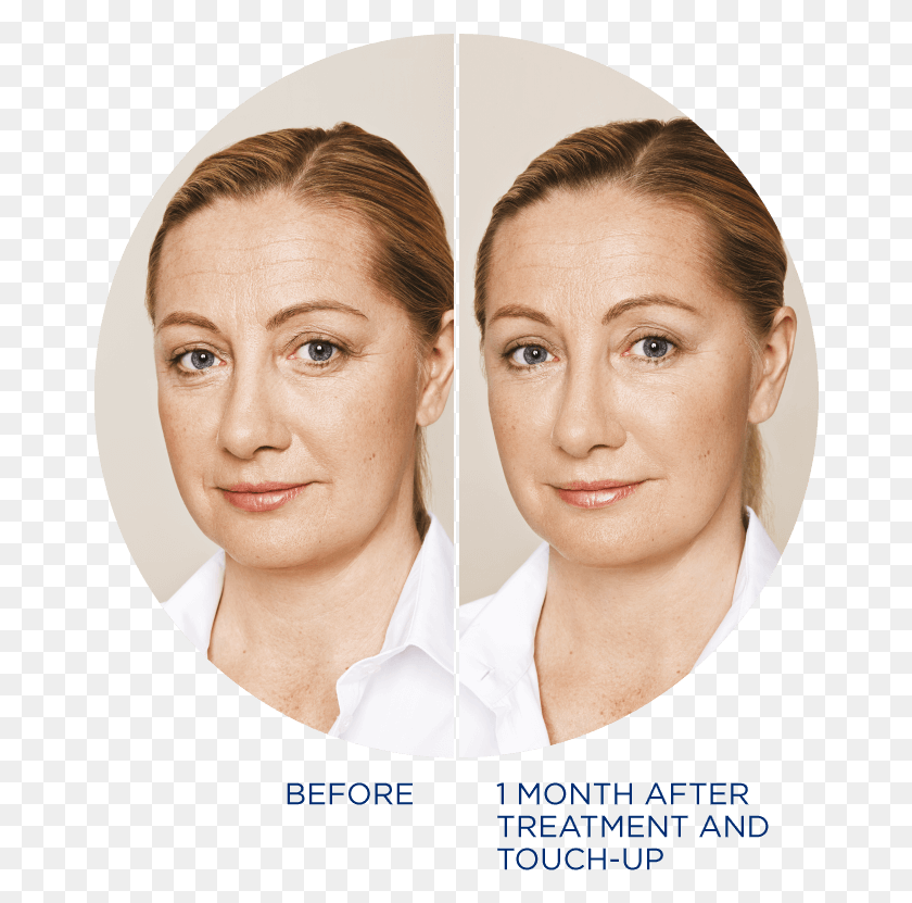 668x771 Restylane Refyne Coconut Oil For Face Wrinkles, Person, Human, Freckle HD PNG Download